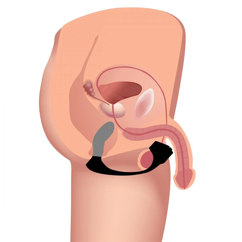 7X Silicone Prostate Plug with Ball Stretcher and Remote - Image 4